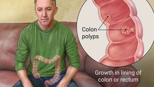 rectal polypectomy